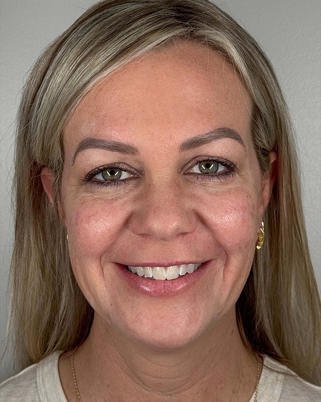 Juvederm Before & After