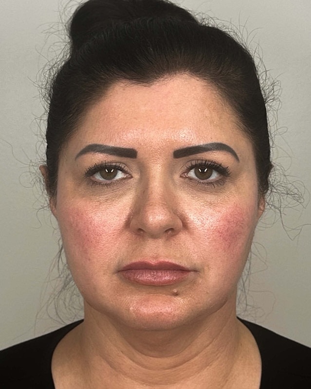 Juvederm Before & After
