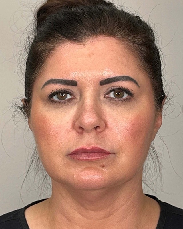 Juvederm Before & After