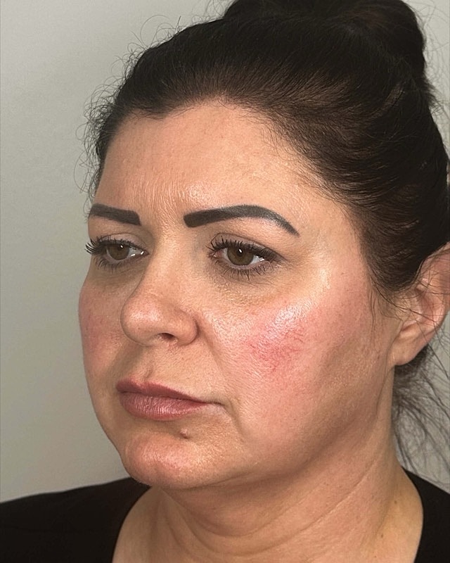 Juvederm Before & After