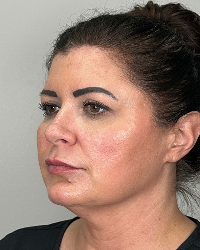 Juvederm Before & After
