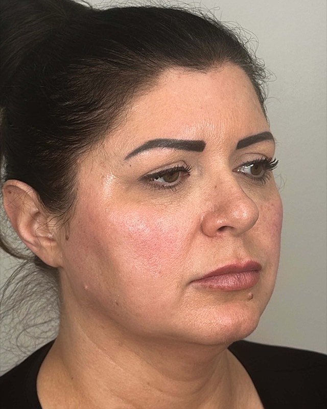 Juvederm Before & After