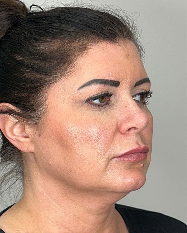 Juvederm Before & After