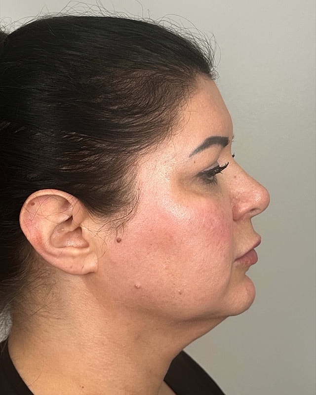 Juvederm Before & After