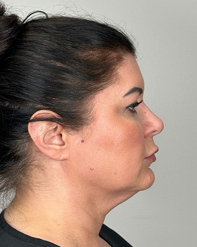 Juvederm Before & After