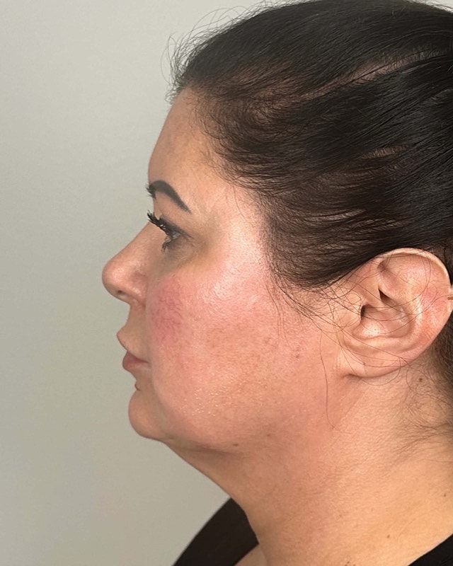 Juvederm Before & After