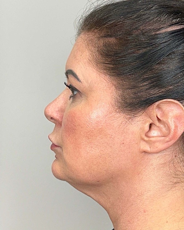 Juvederm Before & After