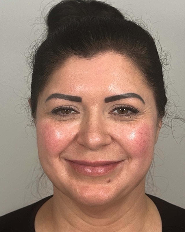 Juvederm Before & After