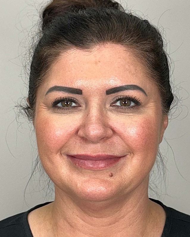 Juvederm Before & After