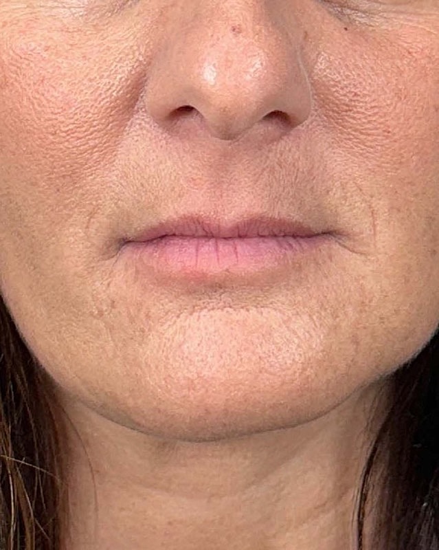 Juvederm Before & After