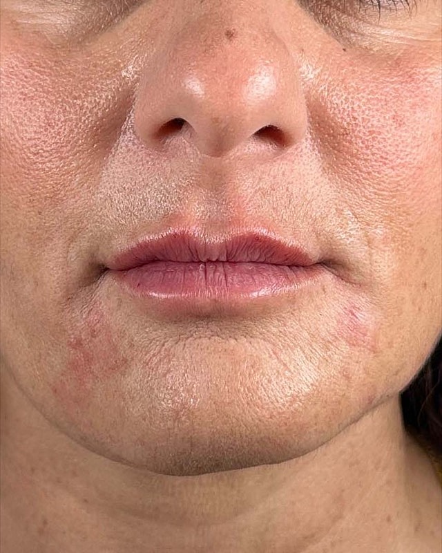 Juvederm Before & After