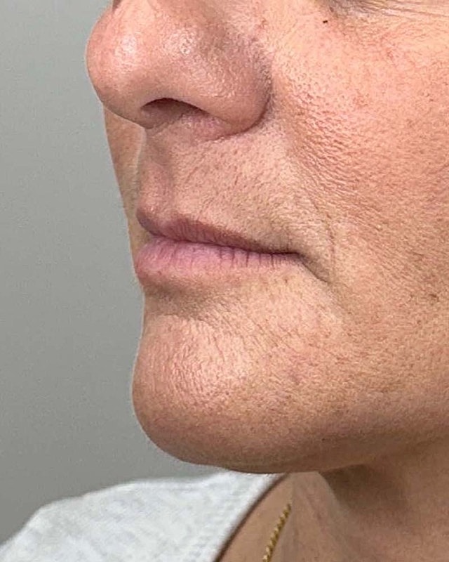 Juvederm Before & After