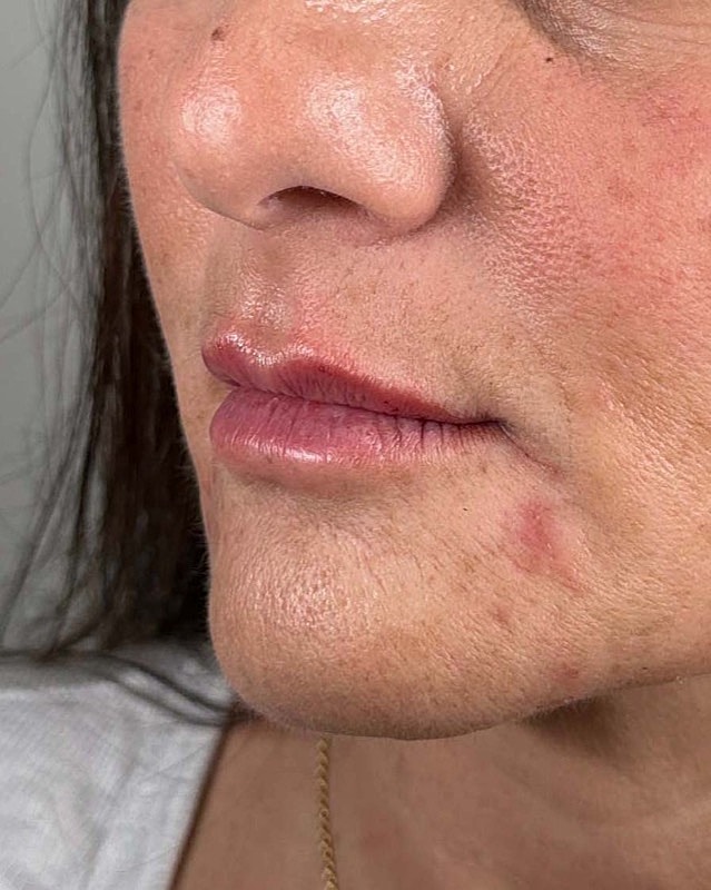 Juvederm Before & After