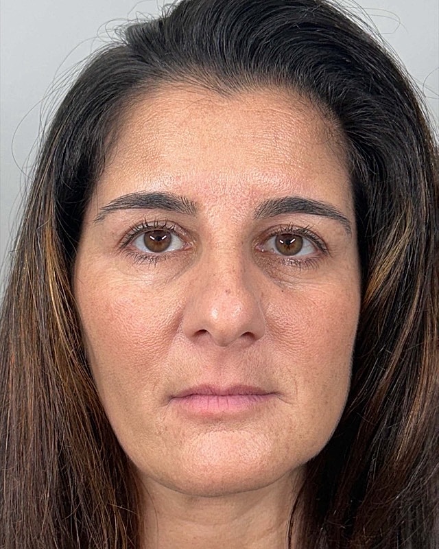 Juvederm Before & After