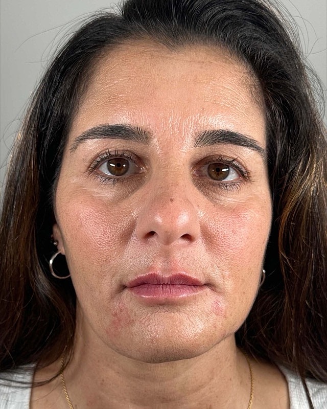 Juvederm Before & After