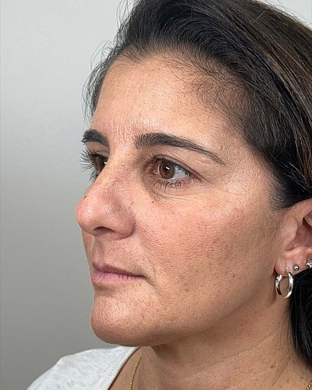 Juvederm Before & After