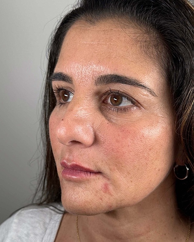 Juvederm Before & After