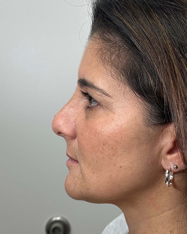 Juvederm Before & After