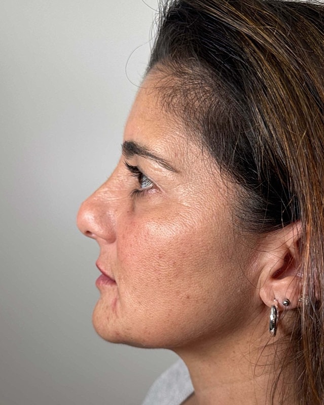 Juvederm Before & After