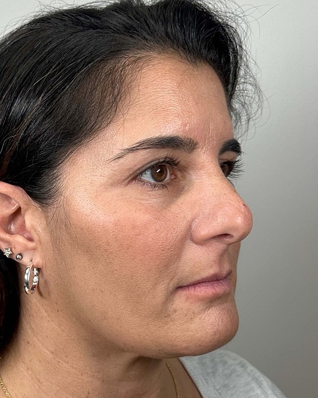 Juvederm Before & After