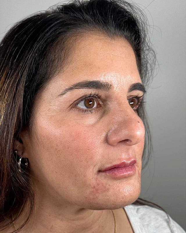 Juvederm Before & After