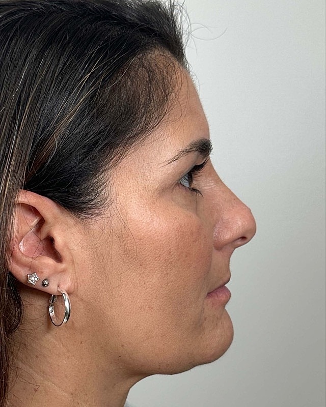 Juvederm Before & After