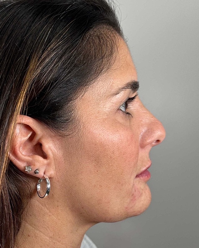 Juvederm Before & After