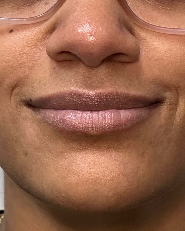 Juvederm Before & After