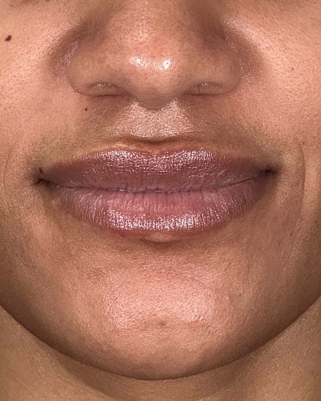 Juvederm Before & After
