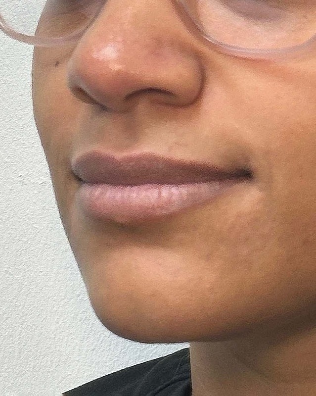 Juvederm Before & After