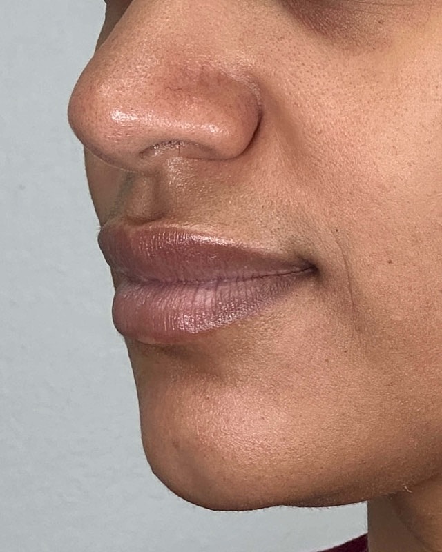 Juvederm Before & After