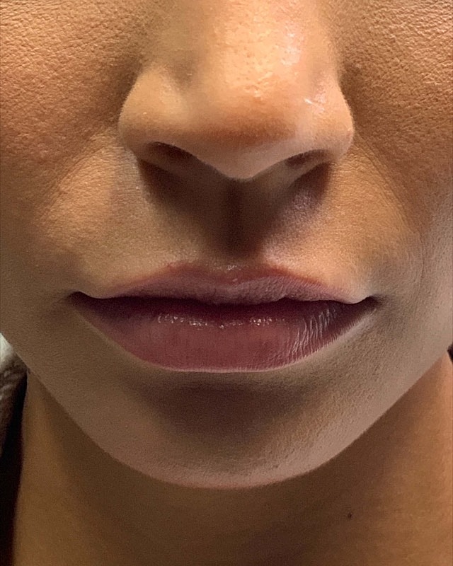 Juvederm Before & After