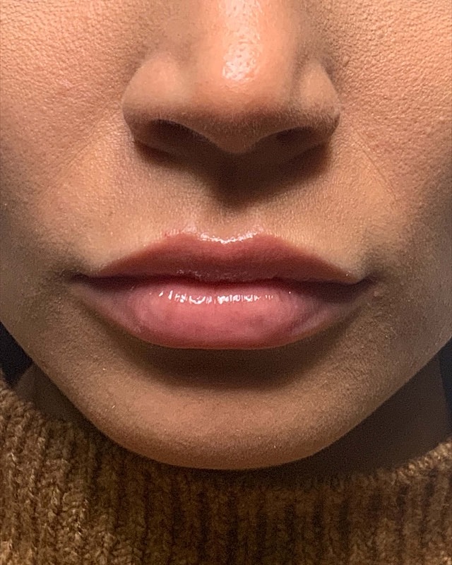 Juvederm Before & After