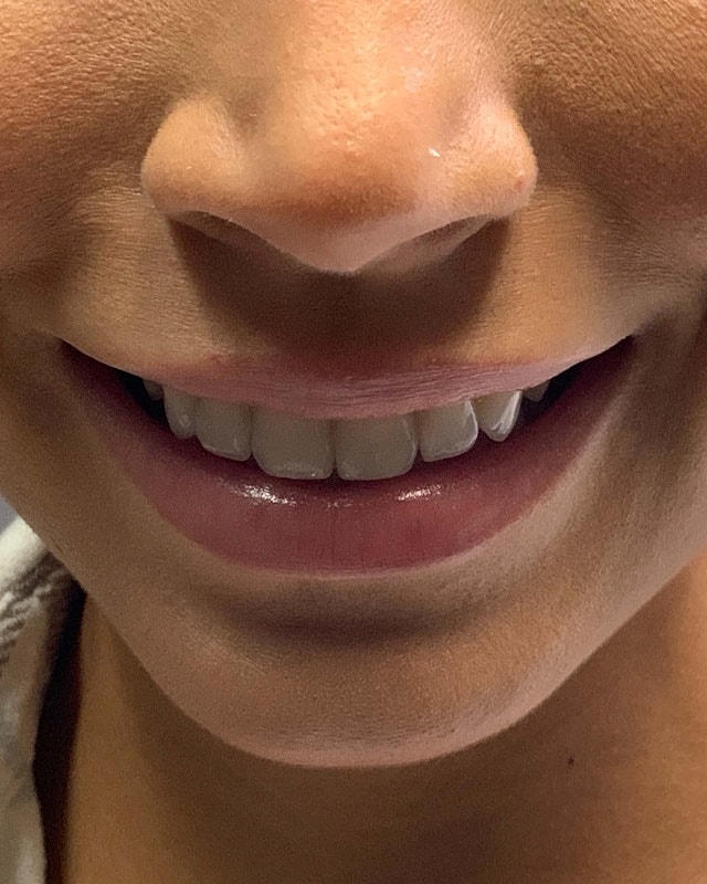 Juvederm Before & After