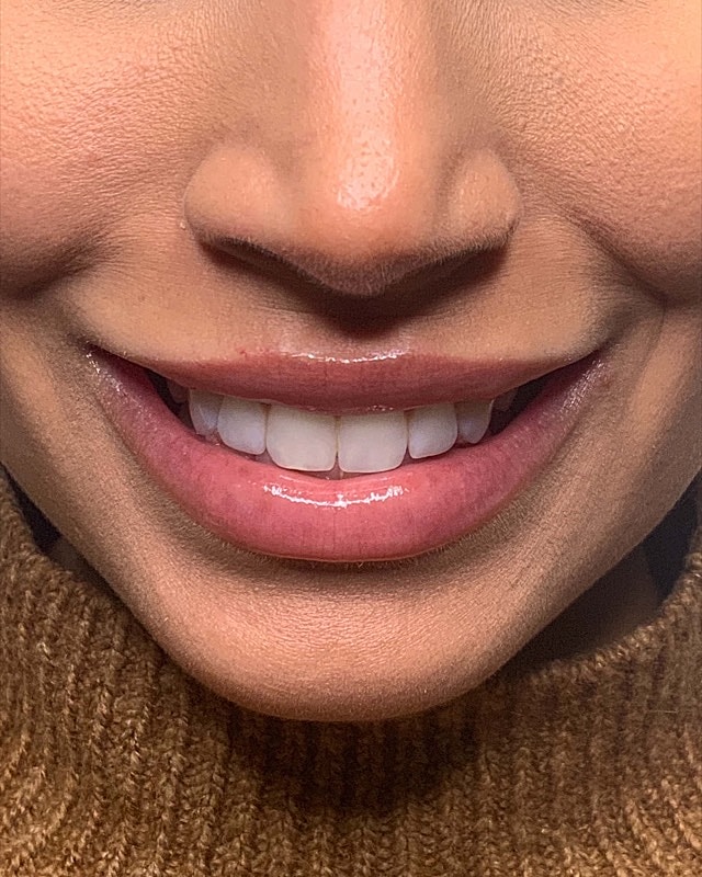 Juvederm Before & After