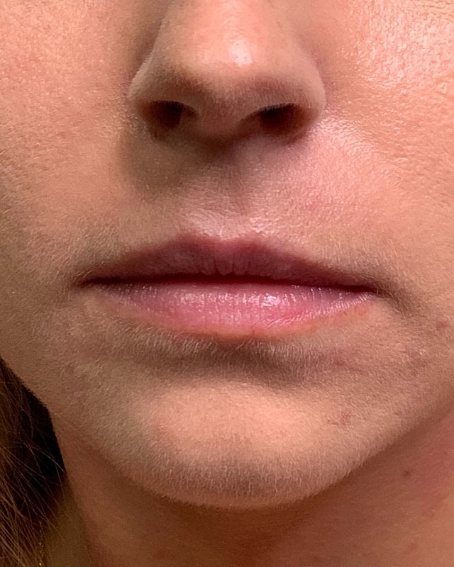 Juvederm Before & After