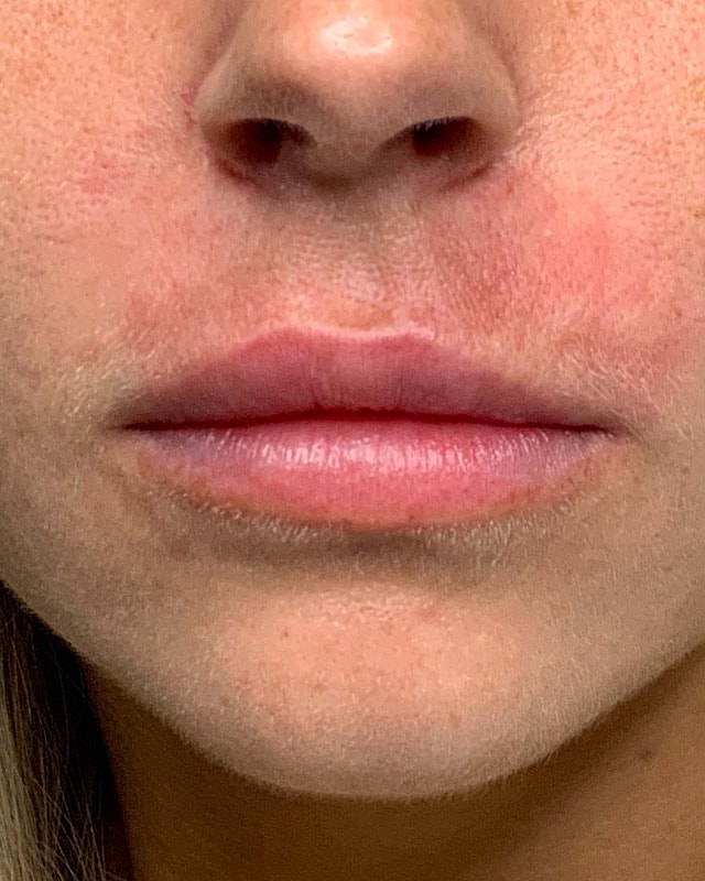 Juvederm Before & After