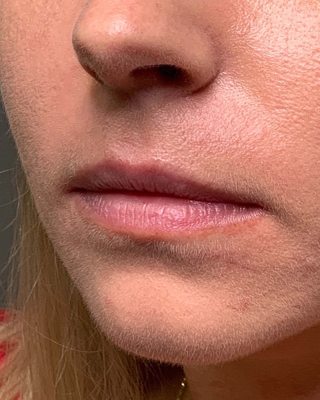 Juvederm Before & After