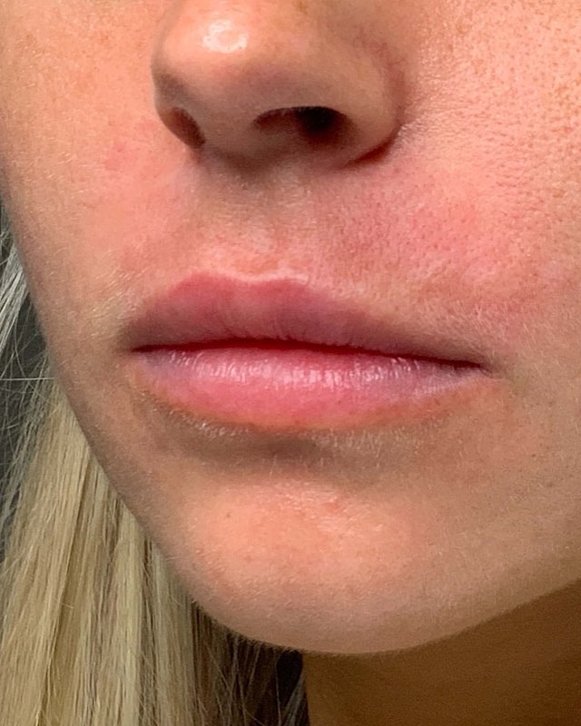 Juvederm Before & After