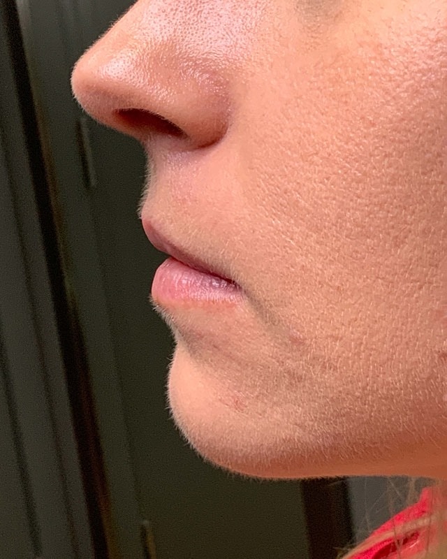 Juvederm Before & After
