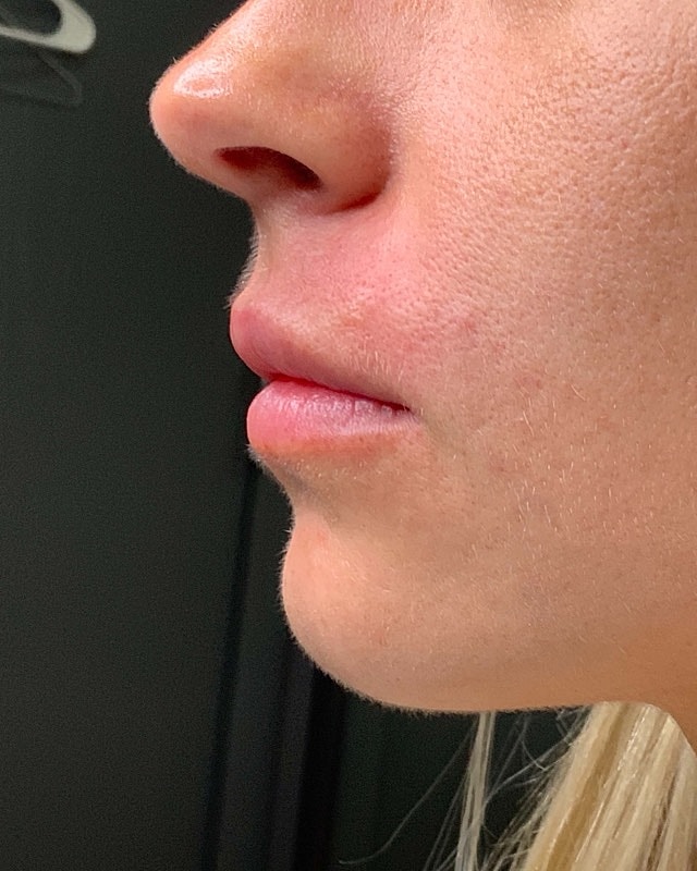 Juvederm Before & After