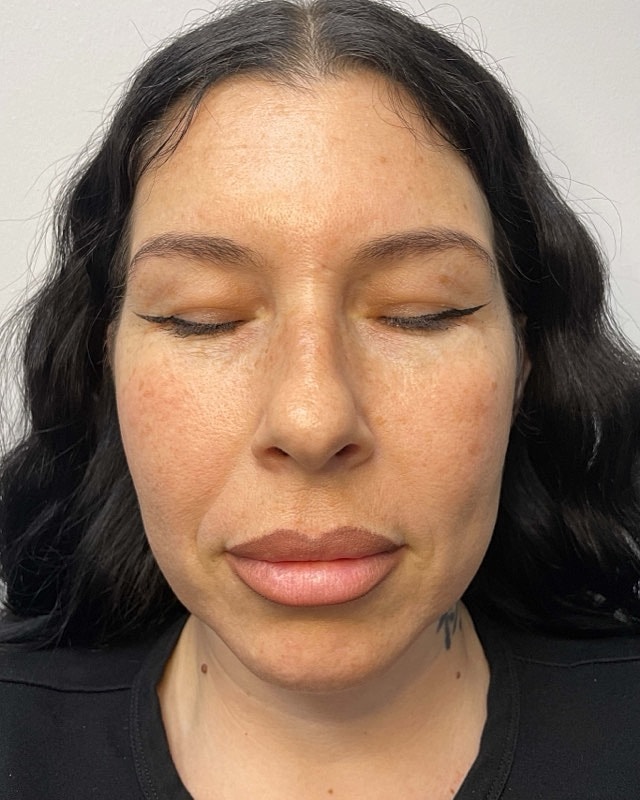 Juvederm Before & After