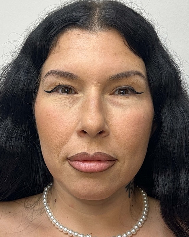 Juvederm Before & After