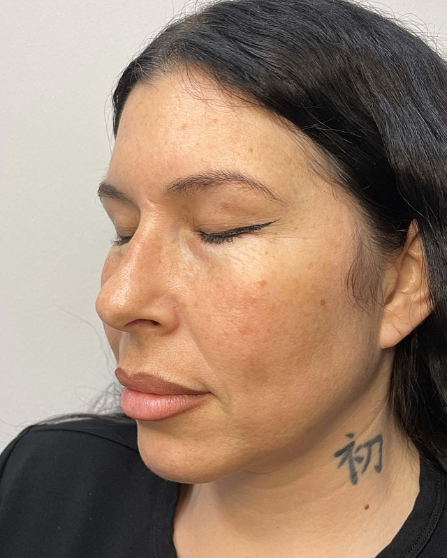 Juvederm Before & After