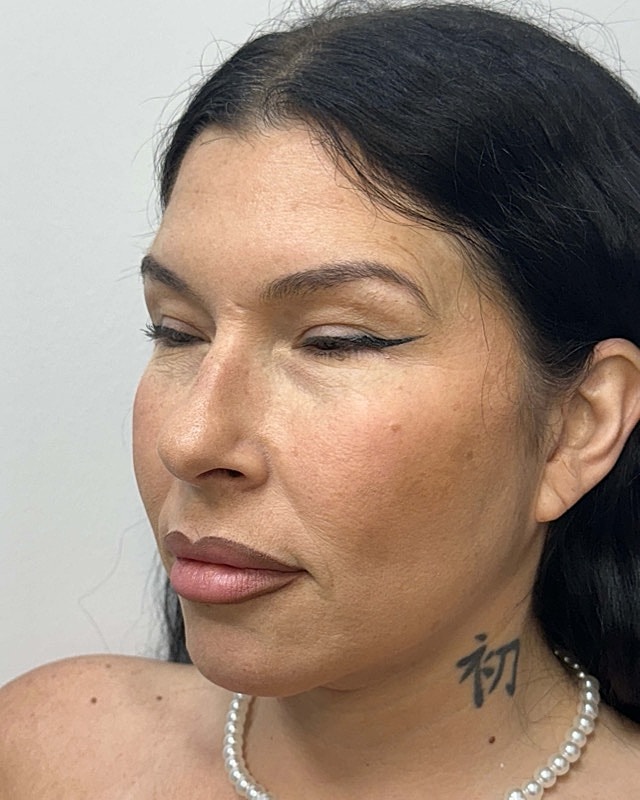 Juvederm Before & After