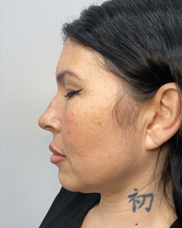 Juvederm Before & After