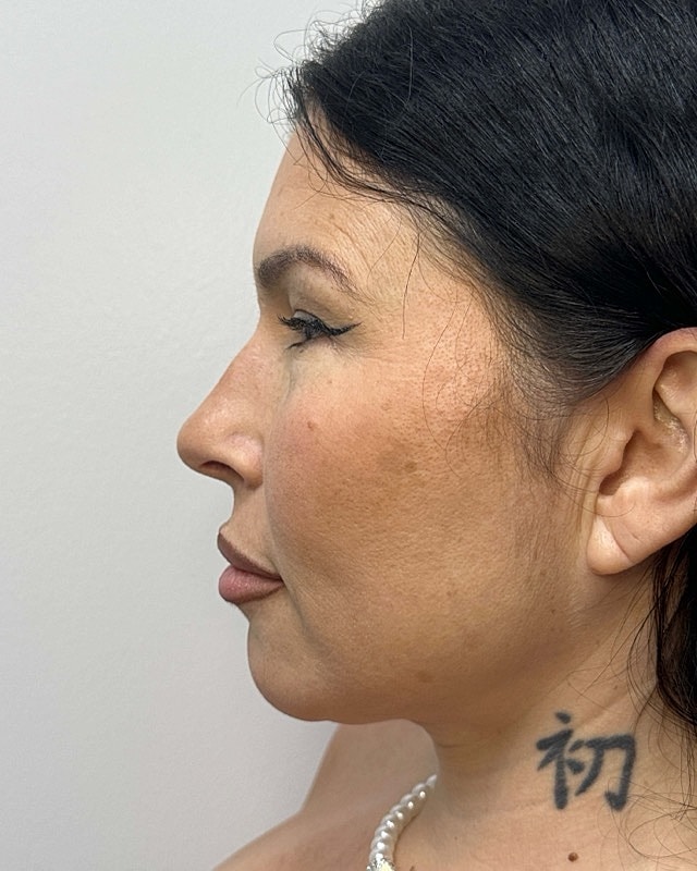 Juvederm Before & After