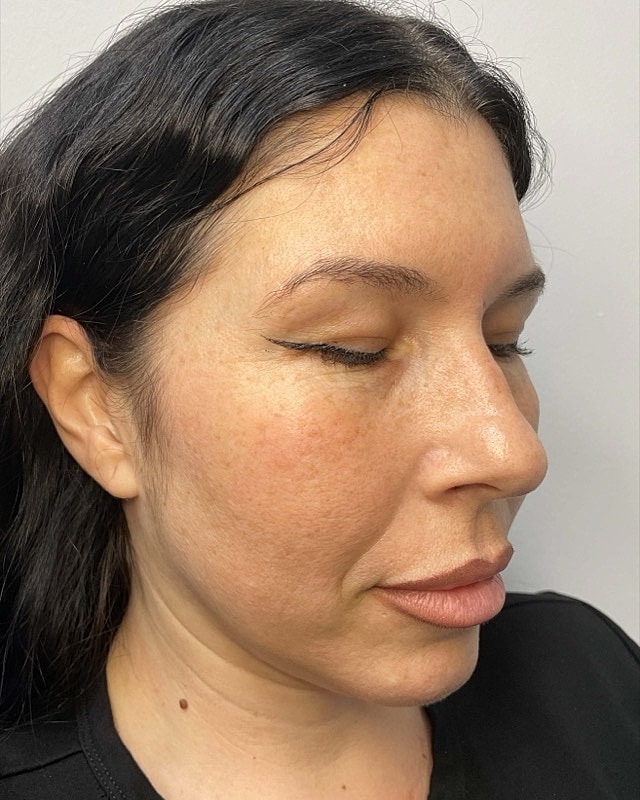 Juvederm Before & After