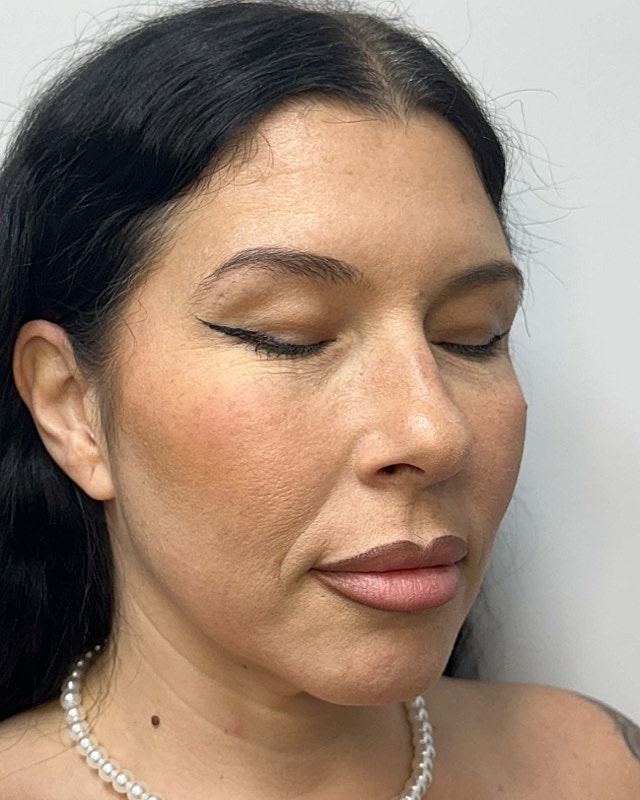 Juvederm Before & After