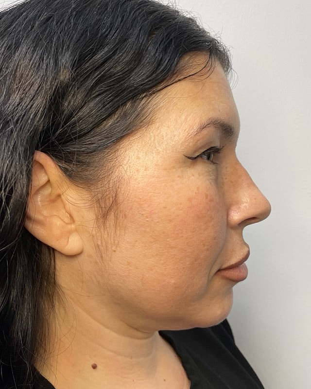 Juvederm Before & After